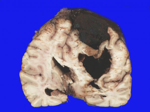 19A2 Congophilic Angiopathy (Case 19) Gross 9