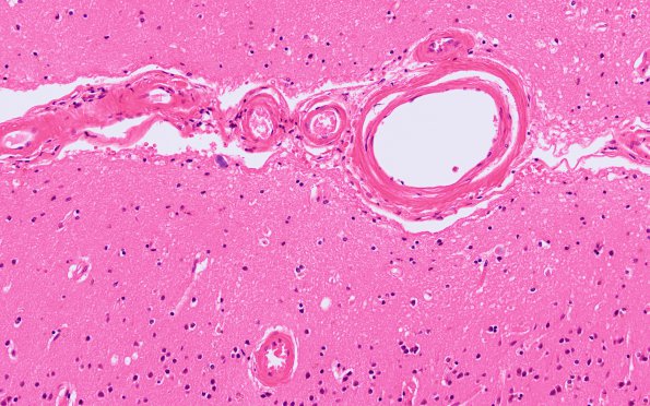 19B1 Congophilic Angiopathy (Case 19) H&E 2