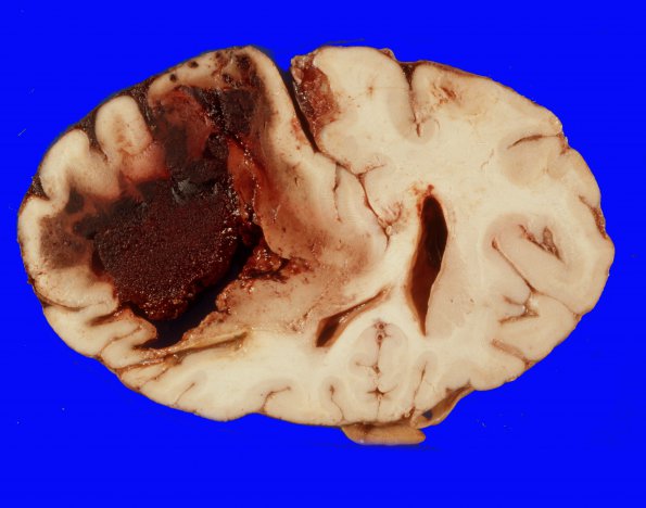 1A1 Congophilic Angiopathy (Case 1) 7A