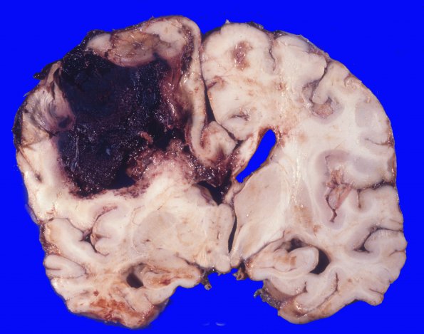 1A2 Congophilic angiopathy (Case 1) A2