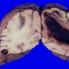 1A3 Congophilic angiopathy (Case 1) A1