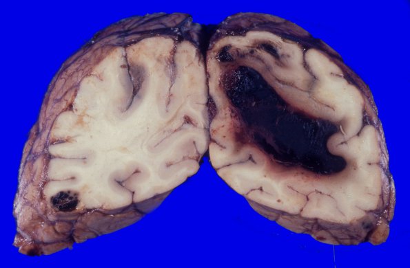 1A3 Congophilic angiopathy (Case 1) A1