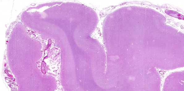 1B1 Congophilic Angiopathy (Case 1) H&E WM 1