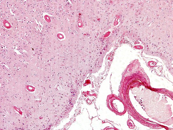 1B3 Congophilic Angiopathy (Case 1) H&E 10