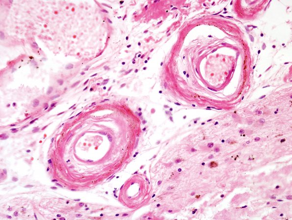 1B4 Congophilic Angiopathy (Case 1) H&E 3