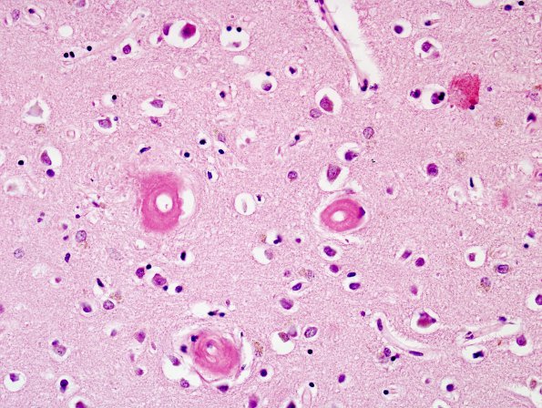 1B7 Congophilic Angiopathy (Case 1) H&E 5