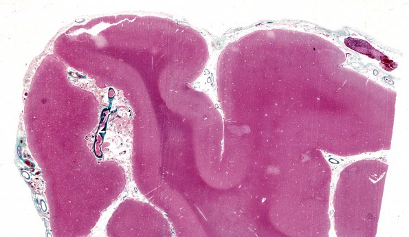 1C1 Congophilic Angiopathy (Case 1) Trichrome WM 1