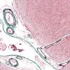 1C2 Congophilic Angiopathy (Case 1) Trichrome 1