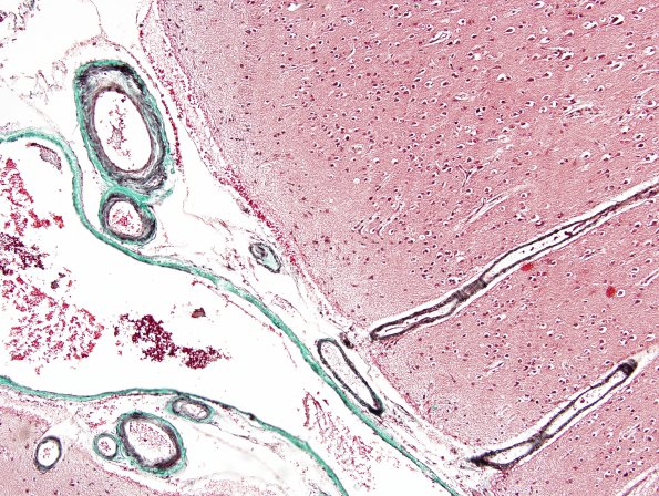 1C2 Congophilic Angiopathy (Case 1) Trichrome 1