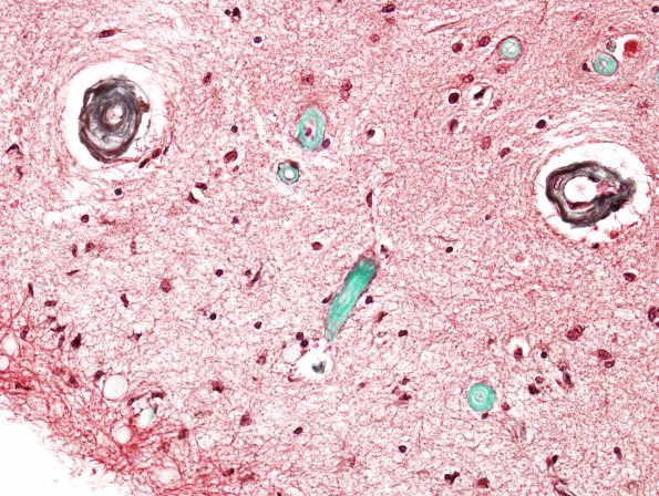 1C3 Congophilic Angiopathy (Case 1) Trichrome 3A