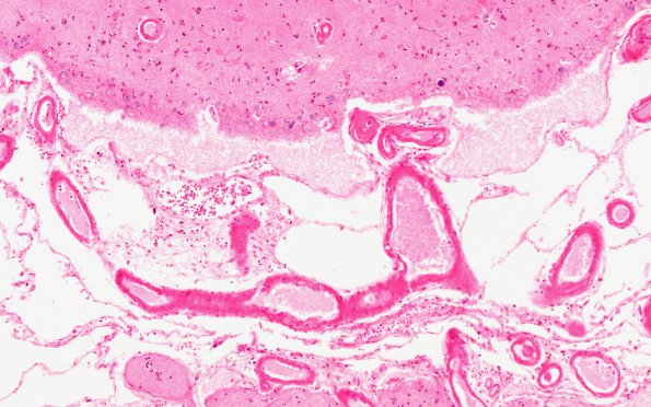 1D1 Congophilic Angiopathy (Case 1) H&E