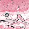 1D2 Congophilic Angiopathy (Case 1) Trichrome 3A