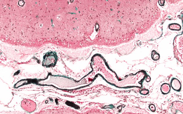 1D2 Congophilic Angiopathy (Case 1) Trichrome 3A