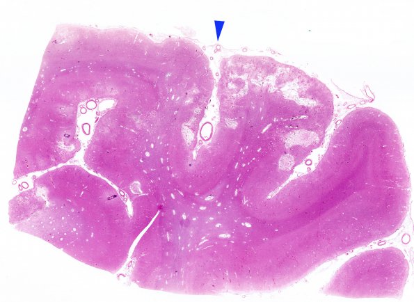 20A1 Congophilic Angiopathy (Case 20) H&E WM