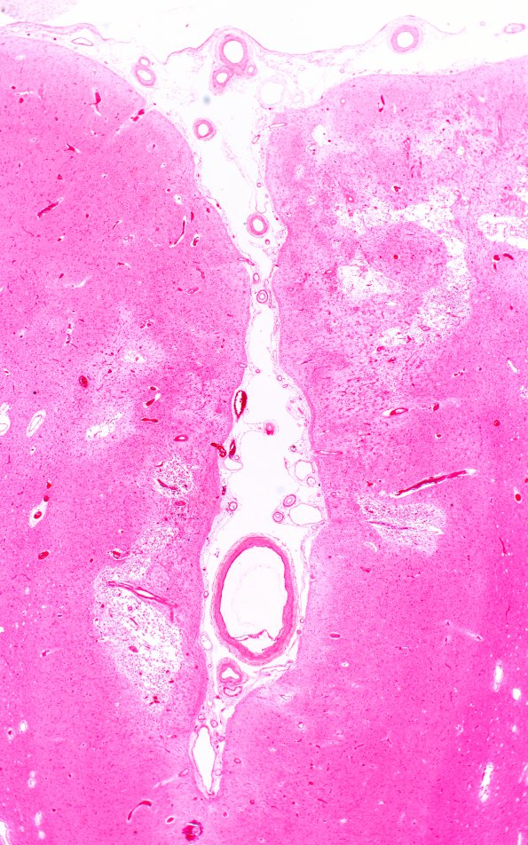 20A2 Congophilic Angiopathy (Case 20) 4A