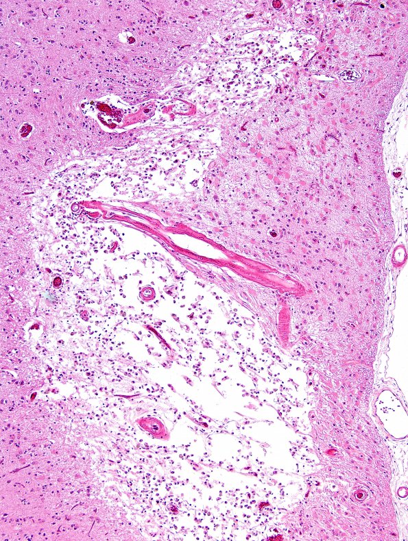 20A5 Congophilic Angiopathy (Case 20) H&E 6