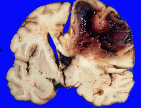 21A1 Congophilic Angiopathy (Case 21) 6