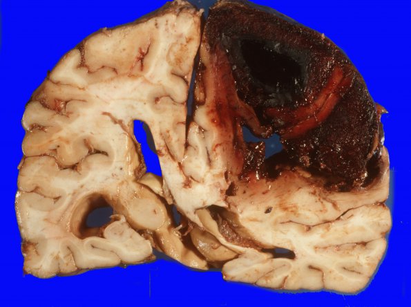 21A2 Congophilic Angiopathy (Case 21) 2A