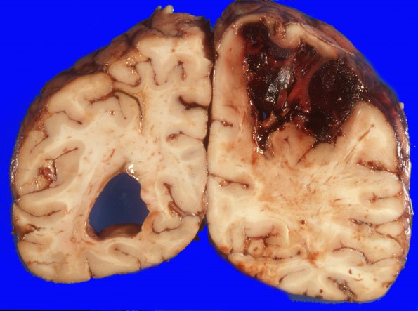 21A3 Congophilic Angiopathy (Case 21) 3A