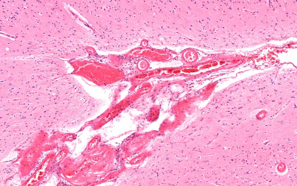 21B1 Congophilic Angiopathy (Case 21) H&E