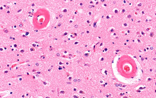 21B2 Congophilic Angiopathy (Case 21) H&E 2