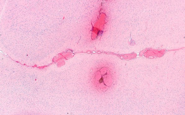 22B1 Hemorrhage, CAA stages (Case 22) N13 2X H&E