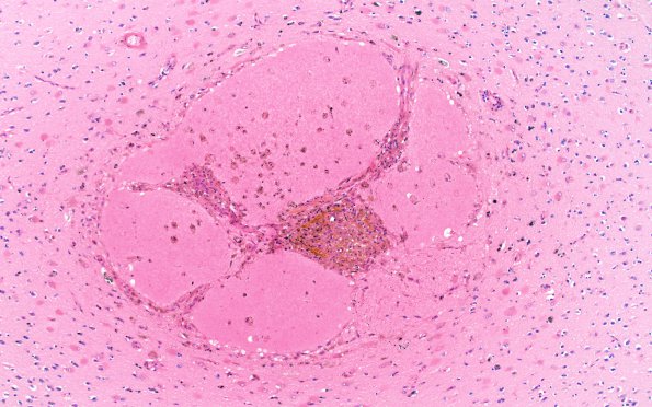 22B2 Hemorrhage, CAA stages (Case 22) N13 20X H&E