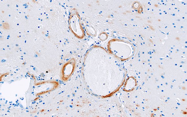 22C Hemorrhage, CAA stages (Case 22) N13 20X BAP