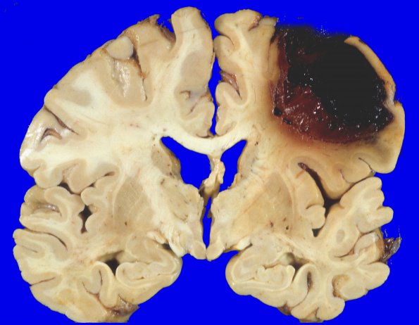 23A1 Congophilic angiopathy (CAA) (Case 23) 1A
