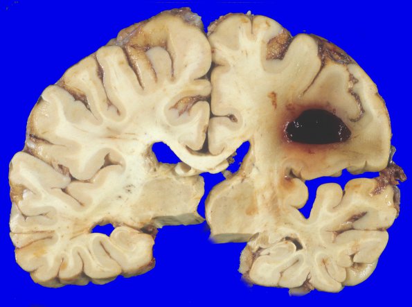 23A2 Congophilic angiopathy (CAA) (Case 23) 2