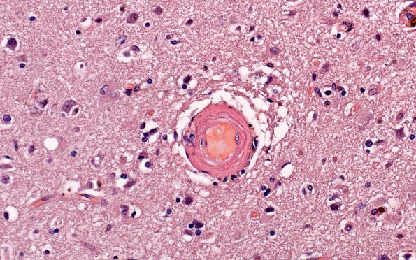 23C1 CAA (Case 23) N11b Congo Red Non-Pol