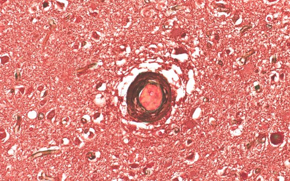 23C3 CAA (Case 23) N11b Masson Trichrome Non-Pol