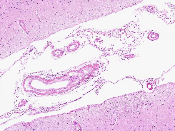 25B1 Congophilic Angiopathy (Case 25) H&E 2A