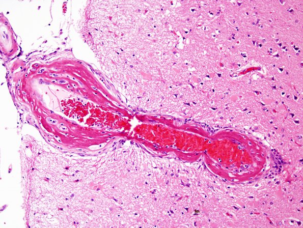 25B2 Congophilic Angiopathy (Case 25) H&E 3A