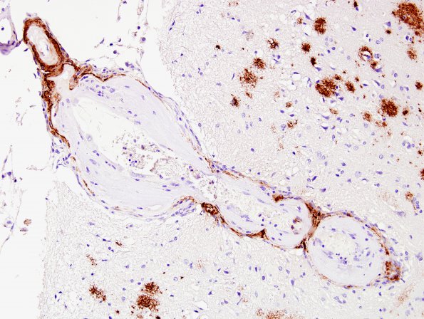 25C1 Congophilic Angiopathy (Case 25) Bamyloid 3A