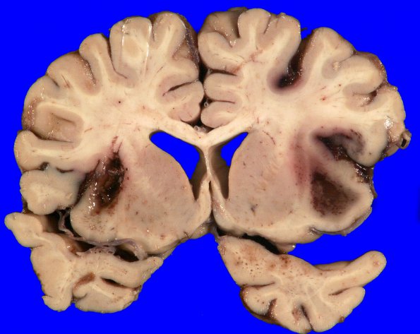 26A1 Congophilic angiopathy (Case 26) _1