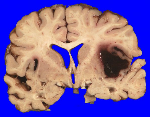 26A2 Congophilic angiopathy (Case 26) _2