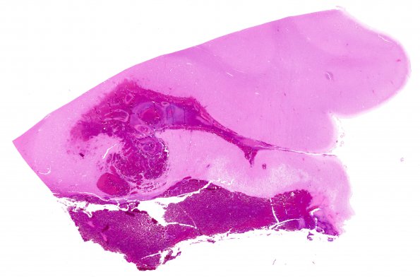 26B1 Congophilic angiopathy (Case 26) 1 H&E WM