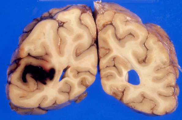 27A2 Congophilic angiopathy (CAA) & AD (Case 27) 3