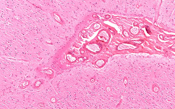 27B1 CAA & AD (Case 27) N1 H&E