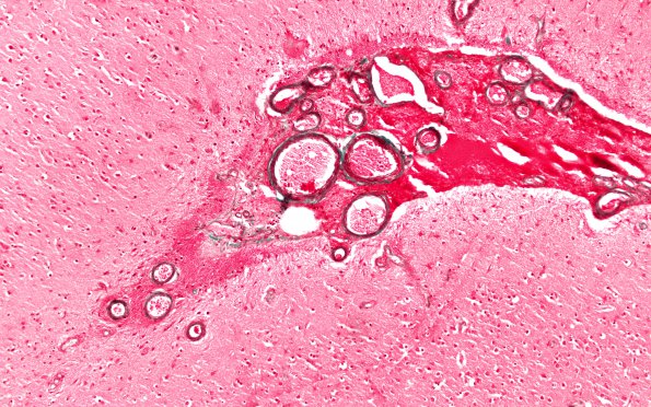 27B2 CAA & AD (Case 27) N1 H&E 2