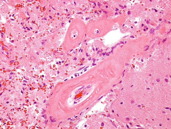 28A2 Congophilic Angiopathy (Case 28) H&E 8