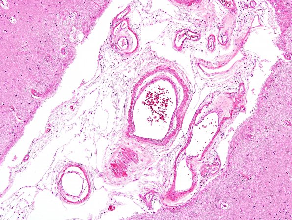 29A2 Congophilic Angiopathy (Case 29) L4 H&E 2