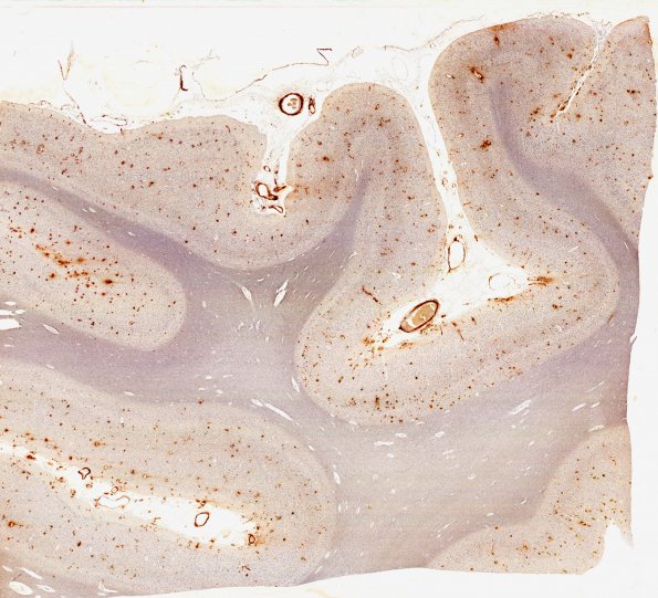 29B1 Congophilic Angiopathy L4 BAmyloid whole mount 1