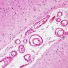 2B1 Congophilic Angiopathy (Case 2) H&E 1