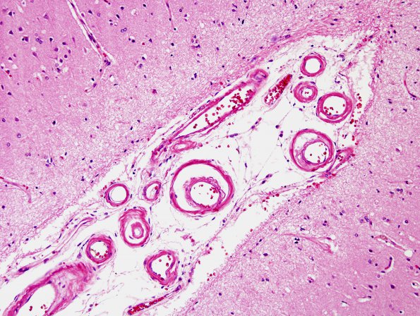 2B1 Congophilic Angiopathy (Case 2) H&E 1