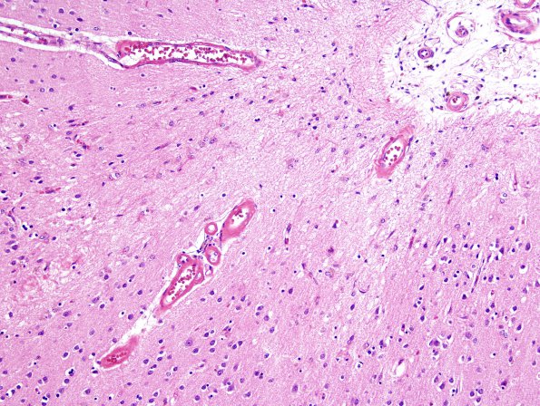 2B3 AD & Congophilic angiopathy (CAA, Case 2) H&E 6