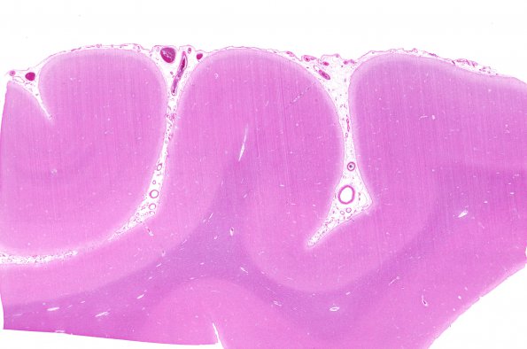 2C1 Congophilic Angiopathy (Case 2) H&E WM (2)