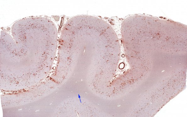 2C2 Congophilic Angiopathy (Case 2) BAP WM copy