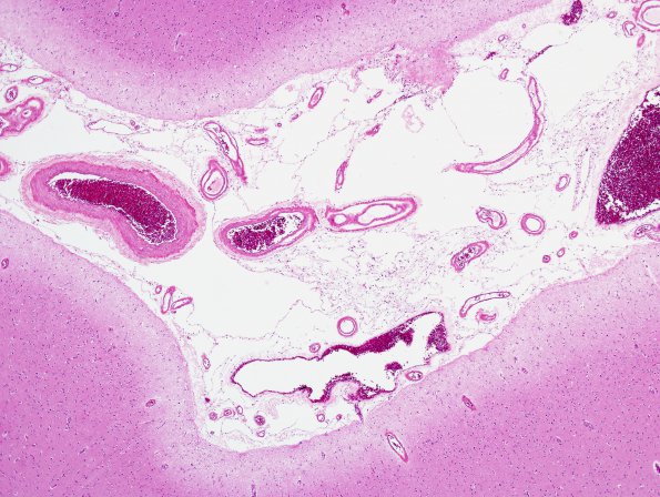 2C3 CAA (Case 2) H&E 3